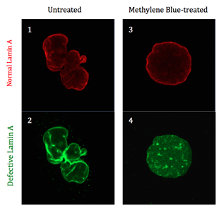 Methylene blue successfully repaired progeria-related defects in the nuclei of human fibroblast cells affected by the disease. The nuclei of untreated cells (panels 1 and 2, left) still exhibit the abnormal convoluted shape characteristic of progeria. The nuclei of cells treated with methylene blue for 8 weeks (panels 3 and 4, right) returned to their normal, rounded shape. The top images were stained with antibodies that attach to the normal lamin A protein, while the bottom images were stained with antibodies that attach to defective lamin A, also known as progerin. Image credit: Kan Cao/Zheng-Mei Xiong/UMD (Click image to download hi-res version.)