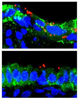 Top: N. gonorrhoeae bacteria (red) penetrate untreated endocervical cells (blue and green). Bottom: N. gonorrhoeae bacteria does not penetrate endocervical cells treated with an inhibitory molecule. Photo: Liang-Chun Wang (Click image to download hi-res version.)