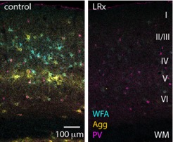 Photomicrographs of the visual cortex. (Left) A typical visual cortex showing the extracellular scaffolding that typically inhibits synaptic plasticity in adults (blue and yellow). (Right) A visual cortex after visual deprivation restricted to the amblyopic eye and light reintroduction. The extracellular scaffold is significantly reduced. Image courtesy of Elizabeth Quinlan. (Click image to download hi-res version)