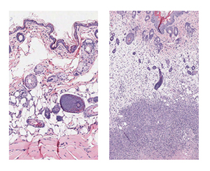 Tissue staining shows group A Streptococcus soft tissue infection at the cellular level. (L-R) Uninfected mouse tissue and mouse tissue 48 hours after infection. The dense dots indicate immune system cells that swarmed in to attempt to control the infection. The densest purple staining toward the bottom is necrotic tissue surrounding bacteria. Image: Joshua Leiberman, UMB (Click image to download hi-res version.)