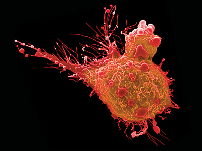 A bladder cancer cell. Image credit: Steve G. Schmeissner/Science Source (Click image to download hi-res version)